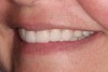 (17.) The postoperative left smile.