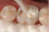 1. Glass ionomer cement (Fuji IX Extra, GC America) being placed as a dentin replacement in this disto-occlusal cavity preparation prior to placement of composite to replace the enamel functional surface.