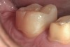 9. A 2-week postoperative view of the mesial occlusal bulk-filled composite restoration in tooth No. 31 prior to placement of the ceramic restoration on tooth No. 30. Note the seamless margin between the restorative material and the tooth with no manipulation or “condensing” of the composite material during placement.