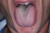 Fig 1. White-tan elongated filiform papillae present in a patient with no saliva collected in 5 minutes. Mouth malodor also present.