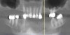 Fig 8. Failing dentition in an 82-year-old patient currently diagnosed with tardive dyskensia.