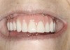Fig 9. Transition line could not be hidden due to uncontrolled contortions of the facial musculature.