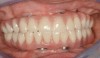 Fig 14. Final restorations used for 6-1/2 additional years.