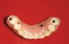 Fig 15. This all-resin interim restoration, which served as a fixed long-term provisional for more than 5 years, is an example of an entry-level option that offers the physiologic benefits of a long-term fixed restoration but with an economic equivalence to a mandibular two-implant overdenture.