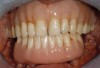 Fig 16. This all-resin interim restoration, which served as a fixed long-term provisional for more than 5 years, is an example of an entry-level option that offers the physiologic benefits of a long-term fixed restoration but with an economic equivalence to a mandibular two-implant overdenture.