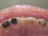Darkened teeth after silver diamine fluoride treatment. Photos courtesy of Dr. Travis Nelson.