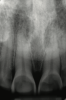 Fig 1. Radiographic image of maxillary incisors presenting signicant radiolucency representative of enamel and dentin loss.