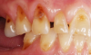 Fig 2. Facial erosion of maxillary (Fig 2) and mandibular (Fig 3) anterior teeth.