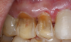 Fig 4. Facial erosion with aggressive abrasion of maxillary anterior teeth. Note pulp exposure on facial surface of canine.