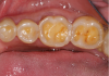 Fig 6. Eroded and worn occlusal surfaces with hollowed out areas.