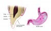 Fig 7. Schematic drawing of area of wear accentuated by acidic demineralization and occlusal forces caused by gastric acid.