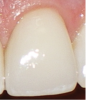 Fig 8. BEWE scoring system: score 0 = no erosive tooth wear (Fig 8); score 1 = initial loss of surface texture (Fig 9); score 2 = distinct defect, hard-tissue loss <50% of surface area (Fig 10); score 3 = hard-tissue loss ≥50% of surface area (Fig 11)