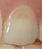 Fig 9. BEWE scoring system: score 0 = no erosive tooth wear (Fig 8); score 1 = initial loss of surface texture (Fig 9); score 2 = distinct defect, hard-tissue loss <50% of surface area (Fig 10); score 3 = hard-tissue loss ≥50% of surface area (Fig 11)