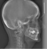 (4.) Lateral x-ray showing a retrognathic and entrapped mandible.