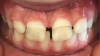 Fig 3. SDF can stain erupting enamel. SDF was applied to the upper incisors while they were still erupting. The enamel at the erupting front (gingival margin) at the time of treatment was immature and porous. Significant amounts of silver penetrated into the enamel and oxidized, becoming apparent. The inciso-gingival extent of the stain shows that only the enamel that had erupted within the previous few weeks took up enough silver to become visible.