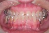 (9.) This patient has lost nearly 40% to 50% of his maxillary anterior tooth structure, yet the teeth are still in full intercuspation due to continued eruption as tooth structure is lost due to wear.
