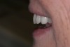 (21.) The provisional restorations show the vertical and horizontal changes in the incisal edge position.