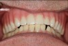 Fig 3. Frontal intraoral view, after placement of maxillary denture in January 2018.