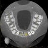 Fig 2. CBCT images: axial (Fig 2) and cross-sectional (Fig 3) views, and 3D reconstruction view (Fig 4) with virtually planned implant Nos. 8 and 9.