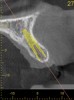 Fig 3. CBCT images: axial (Fig 2) and cross-sectional (Fig 3) views, and 3D reconstruction view (Fig 4) with virtually planned implant Nos. 8 and 9.