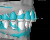 Fig 8. Scans used to mock-up desired restorative result using modeling software. The teal-green areas represent the current tooth form, and the white areas show the desired or digital wax-up. A reduction of 1.009 mm was required prior to preparation, making endodontic treatment likely if orthodontic treatment is not considered.