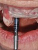 Fig 15. Printed static guide used to precisely control preparation of osteotomy (Fig 14) and delivery of the implant through the guide (Fig 15).