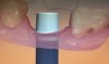 Fig 20. Poor design of the abutment base in the transmucosal region.