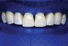 Fig 19. Cleaned tooth surfaces after air abrasion prior to application of adhesive bonding resin composite to close black triangles.