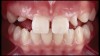 (12.) Intraoral photographs taken with a smartphone and an EALS device for orthodontic evaluation.