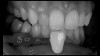 (18.) Tooth shade analysis of value, chroma, and hue taken with a smartphone and an EALS device.
