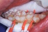 Fig 4. Three thin soft dental picks were used simultaneously for SDF proximal surface saturations in a teenaged patient (Fig 3). After 60 seconds, the treated regions were covered with 5% fluoride varnish (Fig 4). A comparison can be seen of pre-SDF-treatment bitewing films (Fig 5) and 8-month post-SDF bitewing films (Fig 6) for the patient shown in Fig 3 and Fig 4. Radiolucencies were similar or improved, except for contact of maxillary first and second molars.