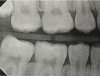 Fig 6. Three thin soft dental picks were used simultaneously for SDF proximal surface saturations in a teenaged patient (Fig 3). After 60 seconds, the treated regions were covered with 5% fluoride varnish (Fig 4). A comparison can be seen of pre-SDF-treatment bitewing films (Fig 5) and 8-month post-SDF bitewing films (Fig 6) for the patient shown in Fig 3 and Fig 4. Radiolucencies were similar or improved, except for contact of maxillary first and second molars.