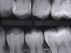 Fig 13. Six-month results of SDF proximal surface saturation in a teenaged patient. As seen in pretreatment bitewing film (Fig 12) and 6-month post-SDF bitewing films (Fig 13 and Fig 14), proximal radiolucencies appeared unchanged while some improved.