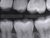 Fig 14. Six-month results of SDF proximal surface saturation in a teenaged patient. As seen in pretreatment bitewing film (Fig 12) and 6-month post-SDF bitewing films (Fig 13 and Fig 14), proximal radiolucencies appeared unchanged while some improved.