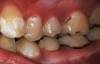 Fig 15. Patient in Fig 12 through Fig 14, immediately before renewed SDF applications. Beginning cervical caries attenuated along with proximal surface attenuation/prevention.