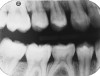 Fig 17. A 15-year-old girl with retained mandibular primary second molar and congenital absence of second premolar (Fig 16). In bitewing film small radiolucencies revealed beginning caries lesions at contact points of primary second molar and adjacent first molar (Fig 17); 12 months later, after initial SDF and 6-month follow-up SDF applications (Fig 18), radiolucencies were not evident.