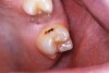 Fig 26. In a separate clinical case, an exfoliated primary second molar had a distal surface caries lesion attenuated with SDF. One year later, as shown, after exfoliation of that tooth, the permanent first molar showed that mesial surface caries progression was intercepted.