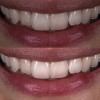 (7.) Photograph reproduced with the brightness increased, demonstrating what only appears to be a size increase in the teeth.