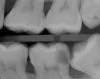 (2.) Bitewing radiograph of tooth No. 18 with radiographic evidence of distal carious defect. This tooth tested within normal limits to cold sensibility tests. Under the current diagnostic terms, the pretreatment pulpal diagnosis would be asymptomatic irreversible pulpitis.