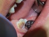 (3.) Pulp polyp present on tooth No. 31.
