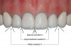 Fig 4. Interincisal angles. A narrow
inverted “V” forms between the two central incisors; asymmetrical inverted “V”s form between the central and lateral incisors; and wide inverted
“V”s form between the lateral incisors and canines.