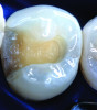 Figure 4. AND Figure 5) The adhesive preparation for composite restorations allows a more conservative design than its amalgam counterpart.