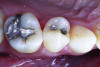 Figure 6. Amalgam is not usually bonded to the walls of the cavity preparation; thus, a space of several microns commonly exists between the restoration and the prepared surfaces. This leads to a potential for microbial invasion and secondary caries, as in this case of these defective amalgam restorations with recurrent decay.