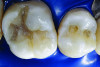 Figure 15. THROUGH Figure 19. Incremental layers of opacious and translucent A2-shaded hybrid composite (Kalore™, GC America) were adapted in an oblique layer to the cavity wall with a long-bladed composite instrument. With this layering technique, the original cavity floor becomes part of the cavity walls, reducing the ratio of cavity volume to area of the cavity walls. Each incremental layer was cured using low-intensity curing light sequences. This process ensures complete adaptation to the underlying resin and tooth structure and reduces shrinkage stress within the restoration.