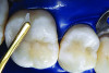 Figure 21. To reproduce the optical effects of the enamel, increments of translucent, B1-shaded, hybrid composite (Kalore) were placed, and the occlusal anatomy was developed by sculpting and smoothing with a sable brush.