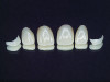 Figure 6. Fabrication of crowns and veneers.