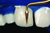 Figure 11. Composite build-up (photograph courtesy of Dr. Newton Fahl).