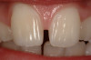 Figure 12. Final conservative esthetic restoration demonstrating the capabilities of composite in creating a virtually invisible restoration by a highly skilled clinician (photo courtesy of Dr. Newton Fahl).