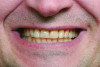 Figure 13. Pretreatment view of dark, worn dentition (photograph courtesy of Jurim Dental Laboratory).
