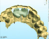 Figure 16. CAD/CAM-designed cantilever bridge.